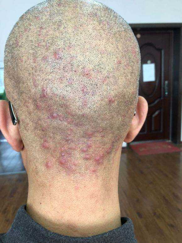 身上得了毛囊炎该怎么治疗